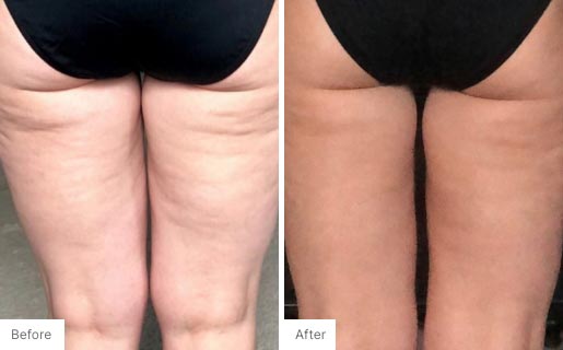8 - Before and After Real Results photo of someone's back thighs.