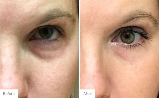 5 - Before and After Real Results photo of a woman's eye area.
